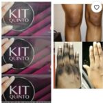 1x Abebi white kit Quinto cream: Clears dark knuckles, elbows, toes, knees safely